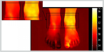 Thermal Imaging to Diagnose Disease