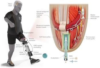 Researchers Explore Robotic Prosthetics That Connect Directly to Bone and Soft Tissue