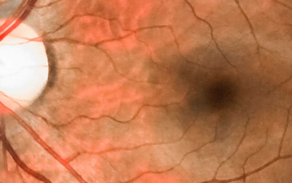Embedded Vision Enhancements for Ophthalmology