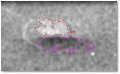 Detection of a dent on a metal surface