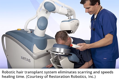 Robotic hair transplant system eliminates scarring and speeds healing time. (Courtesy of Restoration Robotics, Inc.)